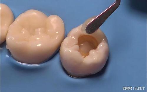 镶牙视频,视频带你领略口腔修复艺术