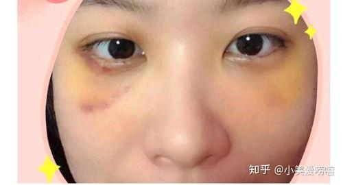 眼袋切除手术视频教程,专业解析与实操步骤