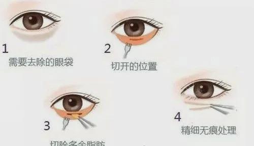 眼袋切除手术视频教程,专业解析与实操步骤