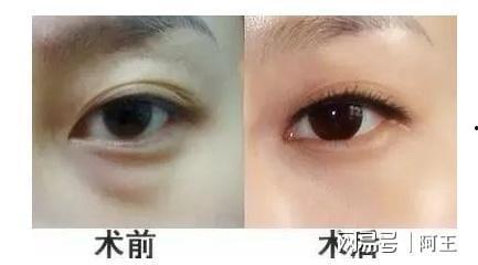眼袋切除手术视频教程,专业解析与实操步骤