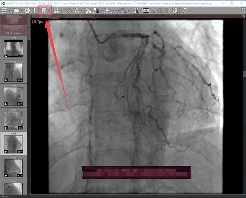 心脏造影视频,血管病变的直观呈现